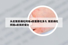 头皮银屑病吃阿维a胶囊要吃多久 银屑病吃阿维a皮损的变化