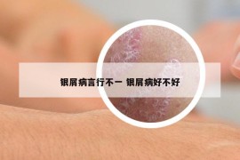 银屑病言行不一 银屑病好不好