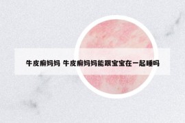 牛皮癣妈妈 牛皮癣妈妈能跟宝宝在一起睡吗