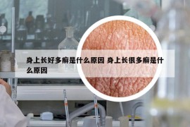 身上长好多癣是什么原因 身上长很多癣是什么原因