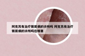 阿克苏有治疗银屑病的诊所吗 阿克苏有治疗银屑病的诊所吗在哪里