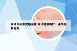 内江民间牛皮癣治疗 内江哪里有好一点的皮肤医院