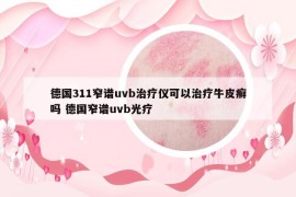 德国311窄谱uvb治疗仪可以治疗牛皮癣吗 德国窄谱uvb光疗