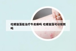 吃螺旋藻能治疗牛皮癣吗 吃螺旋藻可以祛斑吗
