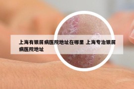 上海有银屑病医院地址在哪里 上海专治银屑病医院地址