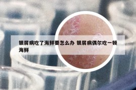 银屑病吃了海鲜要怎么办 银屑病偶尔吃一顿海鲜