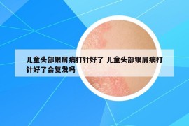 儿童头部银屑病打针好了 儿童头部银屑病打针好了会复发吗