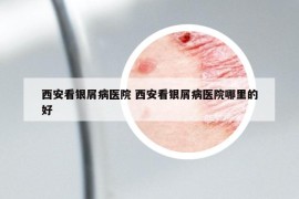 西安看银屑病医院 西安看银屑病医院哪里的好