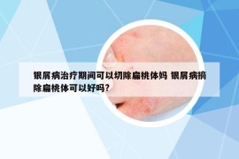 银屑病治疗期间可以切除扁桃体妈 银屑病摘除扁桃体可以好吗?