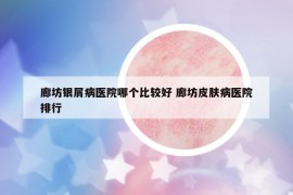 廊坊银屑病医院哪个比较好 廊坊皮肤病医院排行