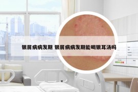 银屑病病发期 银屑病病发期能喝银耳汤吗