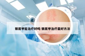 银屑甲能治疗好吗 银屑甲治疗最好方法