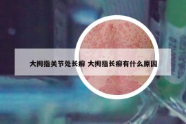 大拇指关节处长癣 大拇指长癣有什么原因