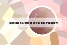 猪苦胆能否治银屑病 猪苦胆治疗皮肤病偏方