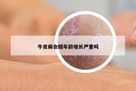 牛皮癣会随年龄增长严重吗
