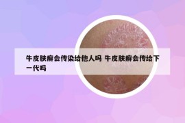 牛皮肤癣会传染给他人吗 牛皮肤癣会传给下一代吗
