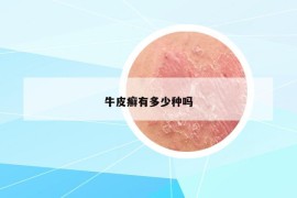 牛皮癣有多少种吗
