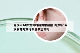 青少年14岁发育时期得银屑病 青少年14岁发育时期得银屑病正常吗