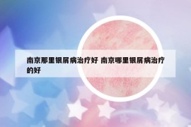 南京那里银屑病治疗好 南京哪里银屑病治疗的好