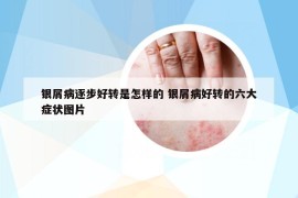 银屑病逐步好转是怎样的 银屑病好转的六大症状图片