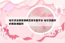 哈尔滨治银屑病典范青年医学会 哈尔滨最好的银屑病医院