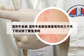湿热牛皮癣 湿热牛皮癣百癣夏塔热吃三个月了可以停了要复发吗