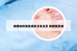 脚踝响和银屑病有没有关系 脚腕银屑病