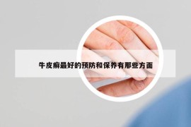 牛皮癣最好的预防和保养有那些方面