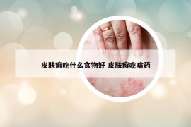 皮肤癣吃什么食物好 皮肤癣吃啥药