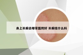 身上长癣去哪家医院好 长癣挂什么科