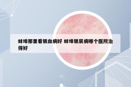 蚌埠那里看银血病好 蚌埠银屑病哪个医院治得好