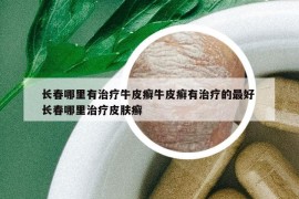 长春哪里有治疗牛皮癣牛皮癣有治疗的最好 长春哪里治疗皮肤癣