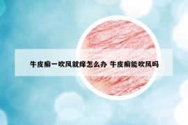 牛皮癣一吹风就痒怎么办 牛皮癣能吹风吗
