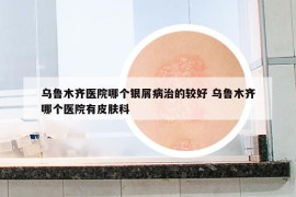 乌鲁木齐医院哪个银屑病治的较好 乌鲁木齐哪个医院有皮肤科