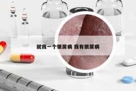 就我一个银屑病 我有银屑病
