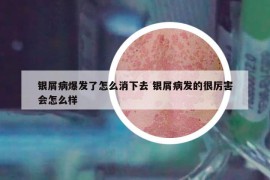 银屑病爆发了怎么消下去 银屑病发的很厉害会怎么样