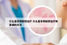 什么是生物制剂治疗 什么是生物制剂治疗银屑病的方法