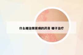 什么硼治银屑病的药膏 硼子治疗