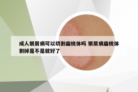 成人银屑病可以切割扁桃体吗 银屑病扁桃体割掉是不是就好了