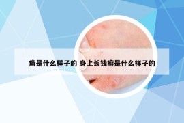 癣是什么样子的 身上长钱癣是什么样子的