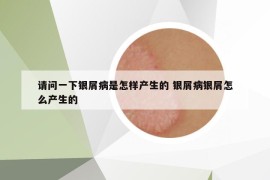 请问一下银屑病是怎样产生的 银屑病银屑怎么产生的