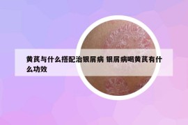 黄芪与什么搭配治银屑病 银屑病喝黄芪有什么功效