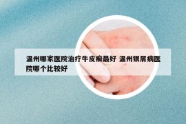 温州哪家医院治疗牛皮癣最好 温州银屑病医院哪个比较好