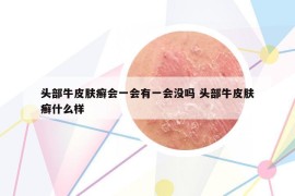 头部牛皮肤癣会一会有一会没吗 头部牛皮肤癣什么样