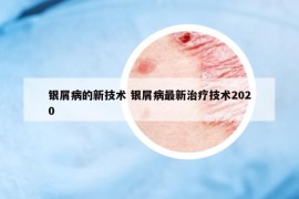 银屑病的新技术 银屑病最新治疗技术2020