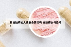 和皮肤癣的人接触会传染吗 皮肤癣会传染吗?