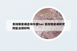 贵阳银屑病咨询中康hao 贵阳银屑病研究院能治得好吗