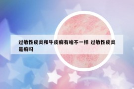 过敏性皮炎和牛皮癣有啥不一样 过敏性皮炎是癣吗