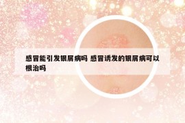 感冒能引发银屑病吗 感冒诱发的银屑病可以根治吗