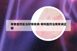 哪里医院能治好银屑病 哪所医院治银屑病正规